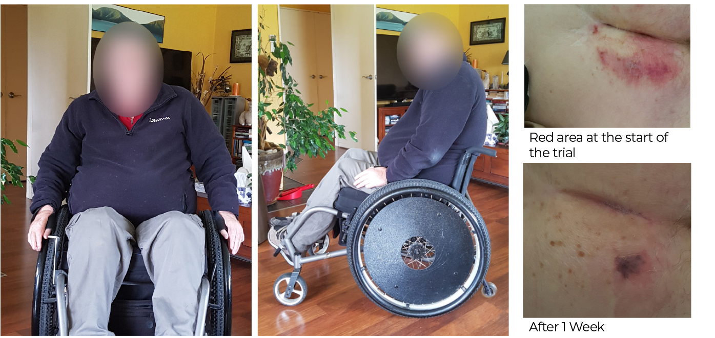 Clinical Case: Actively assisting in healing a pressure injury with the Vicair Active O2