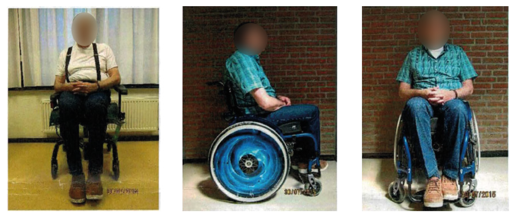 Clinical Case: Treatment of a category II pressure ulcer and improved asymmetric positioning through Vicair